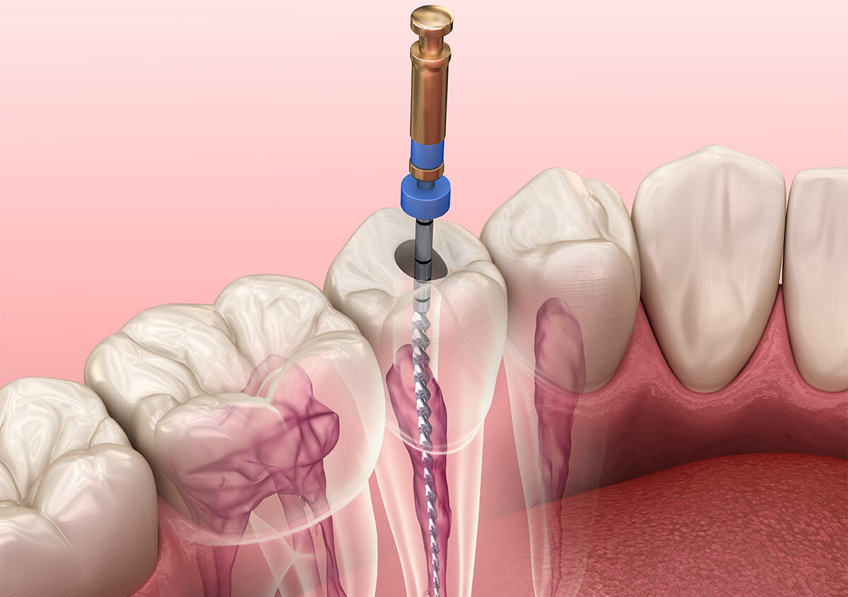 Urgent Root Canal Treatment in Denver CO Area